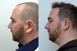 زراعة الشعر للرجال في دبي زراعة الشعر للرجال في أبو ظبي