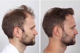 زراعة الشعر للرجال في دبي زراعة الشعر للرجال في دبي