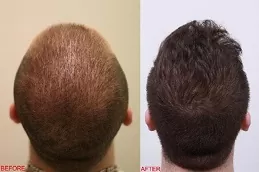 زراعة شعر التاج في أبو ظبي