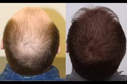 زراعة شعر التاج في دبي