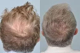 زراعة شعر التاج في والشارق