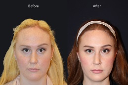 زراعة شعر الحاجب زراعة شعر الحاجب في والشارق