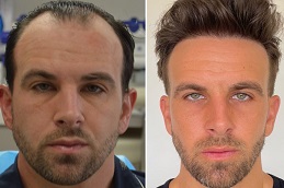 زراعة الشعر للرجال في دبي ززراعة الشعر للرجال في والشارق
