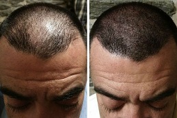 صبغ فروة الرأس المجهري في أبو ظبي