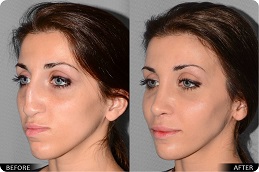 عملية تجميل الأنف في أبو ظبي