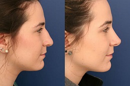 عملية تجميل الأنف في دبي