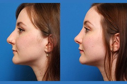عملية تجميل الأنف في والشارق