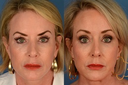 Before-After-Forehead-Lift-Surgery-in-Abu-Dhabi-