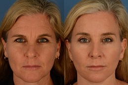 Before-After-Forehead-Lift-Surgery-in-Abu-Dhabi-Al-Ain