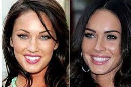 Hollywood-Smile-Makeover-in-Abu-Dhabi-Al-Ain