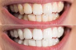 Hydrogen-Peroxide-Whitening-in-Abu-Dhabi-Al-Ain-1