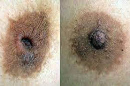 جراحة الحلمة المقلوبة Inverted-Nipple-surgery