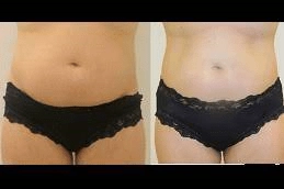 Liposonix-Treatment