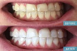 Teeth-Whitening-Abu-Dhabi