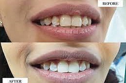 Teeth-Whitening-in-Abu-Dhabi-Al-Ain