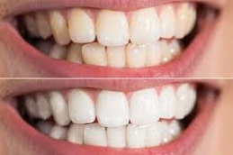 Teeth-Whitening-in-Abu-Dhabi