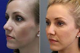 beletero-fillers-clinic-in-abu-dhabi-al-ain