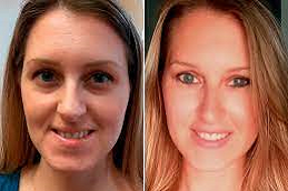 beletero-fillers-clinic-in-abu-dhabi
