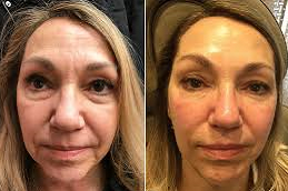 beletero-fillers-clinic