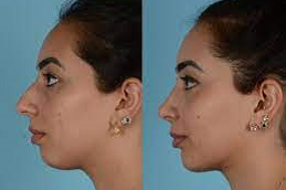 تكلفة تجميل الأنف في دبي وأبو ظبي والشارقة والعين