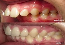 علاج الأسنان البارزة