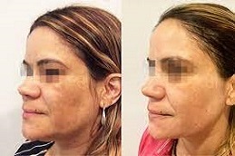 علاج بيكو جينيسيس في دبي وأبو ظبي والشارقة والعين