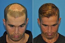 زراعة الشعر بدون سكار في دبي وأبو ظبي والشارقة والعين