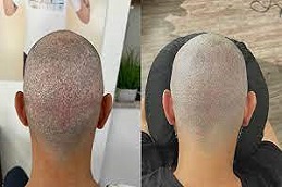 زراعة الشعر بدون سكار في دبي وأبو ظبي والشارقة والعين