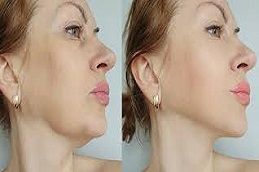 عملية تصغير الذقن في دبي وأبو ظبي والشارقة والعين
