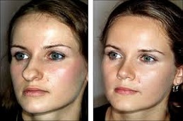 تجميل الأنف المغلق في دبي وأبو ظبي والشارقة والعين
