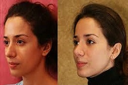 تجميل الأنف المغلق في دبي وأبو ظبي والشارقة والعين
