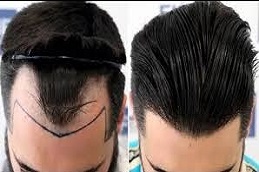زراعة الشعر للرجال في دبي عملية زراعة الشعر للرجال في دبي وأبو ظبي والشارقة والعين