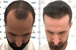 زراعة الشعر للرجال في دبي عملية زراعة الشعر للرجال في دبي وأبو ظبي والشارقة والعين