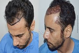 زراعة الشعر باستخدام تقنية FUT في دبي وأبو ظبي