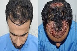 زراعة الشعر باستخدام تقنية FUT في دبي وأبو ظبي