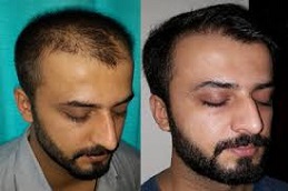 زراعة الشعر باستخدام تقنية FUT في دبي وأبو ظبي