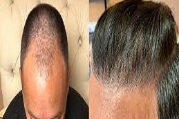 زراعة الشعر باستخدام تقنية FUT في دبي وأبو ظبي