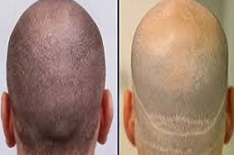 زراعة الشعر باستخدام تقنية FUT في دبي وأبو ظبي