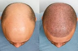زراعة الشعر باستخدام تقنية FUT في دبي وأبو ظبي
