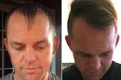 زراعة الشعر بالروبوت زراعة الشعر بالروبوت في دبي وأبوظبي والشارقة والعين
