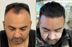 زراعة الشعر بالروبوت زراعة الشعر بالروبوت في دبي وأبوظبي والشارقة والعين