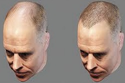 زراعة الشعر بالروبوت زراعة الشعر بالروبوت في دبي وأبوظبي والشارقة والعين