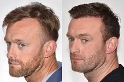 زراعة الشعر بالروبوت زراعة الشعر بالروبوت في دبي وأبوظبي والشارقة والعين