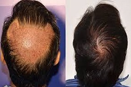 زراعة الشعر التاج في دبي وأبوظبي والشارقة والعين