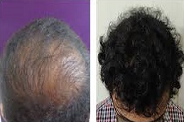 زراعة الشعر التاج في دبي وأبوظبي والشارقة والعين
