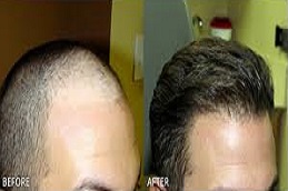 زراعة الشعر بالاقتطاف علاج زراعة الشعر بالاقتطاف في دبي وأبو ظبي والشارقة والعين