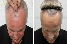 زراعة الشعر بالاقتطاف علاج زراعة الشعر بالاقتطاف في دبي وأبو ظبي والشارقة والعين