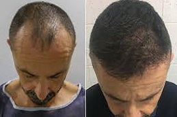 زراعة الشعر بالاقتطاف علاج زراعة الشعر بالاقتطاف في دبي وأبو ظبي والشارقة والعين