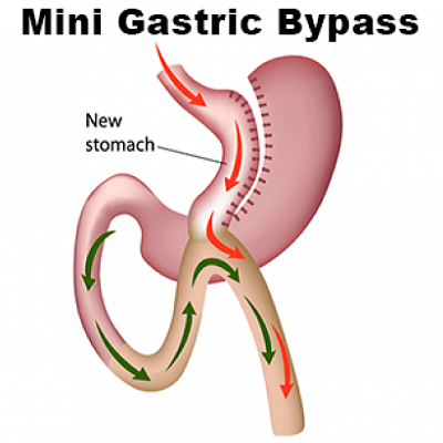 تحويل مسار المعدة المصغر تحويل مسار المعدة المصغر في دبي وأبو ظبي والشارقة والعين