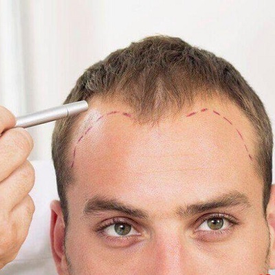 زراعة الشعر للرجال في دبي زراعة الشعر للرجال في دبي وأبو ظبي والشارقة والعين